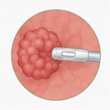 カテーテルの先端を腫瘍に当てる
