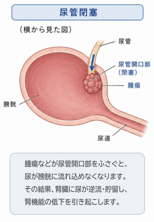 尿管閉塞の状態のイラスト解説