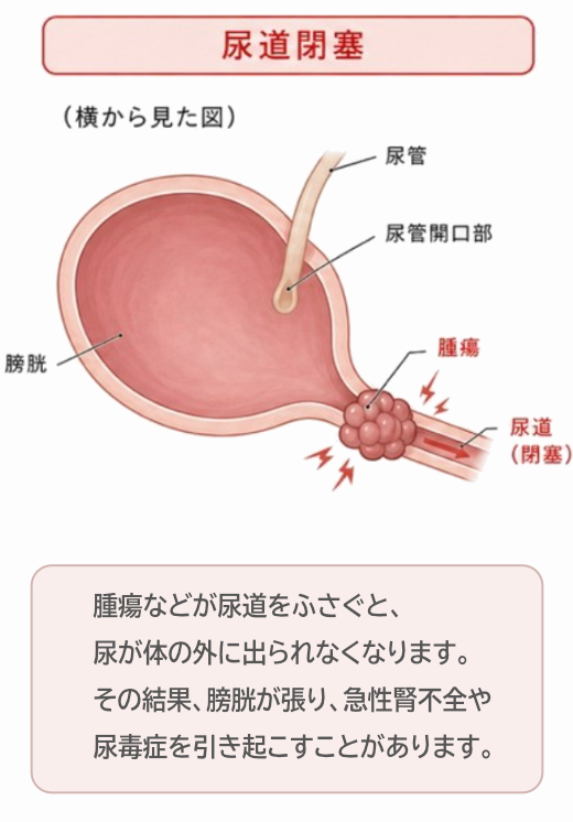 尿道閉塞の状態のイラスト解説