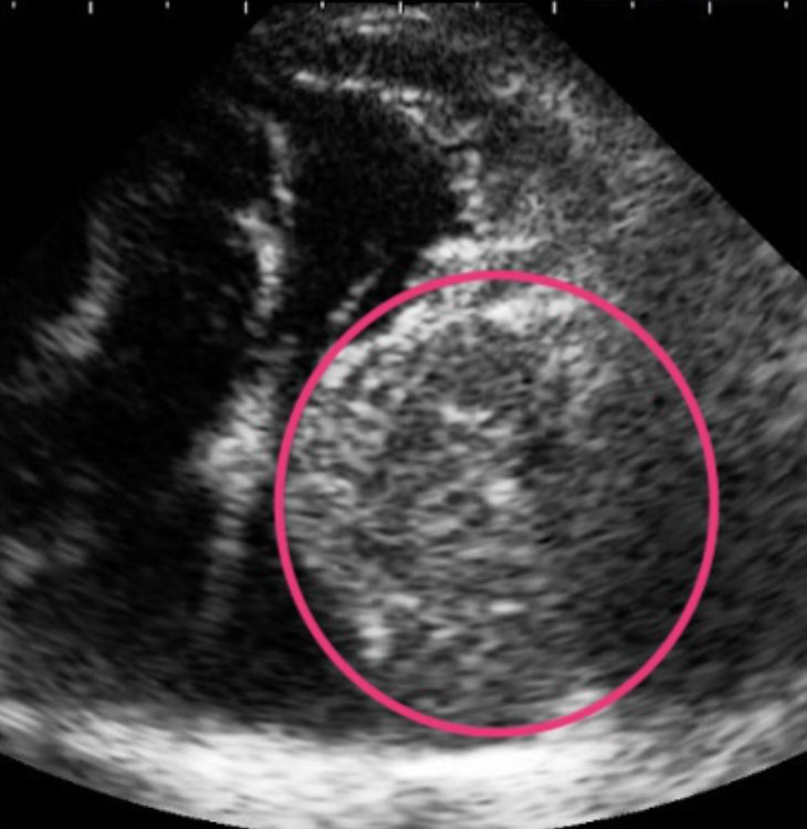 ⼼臓超⾳波検査で確認された⼼臓腫瘍の例