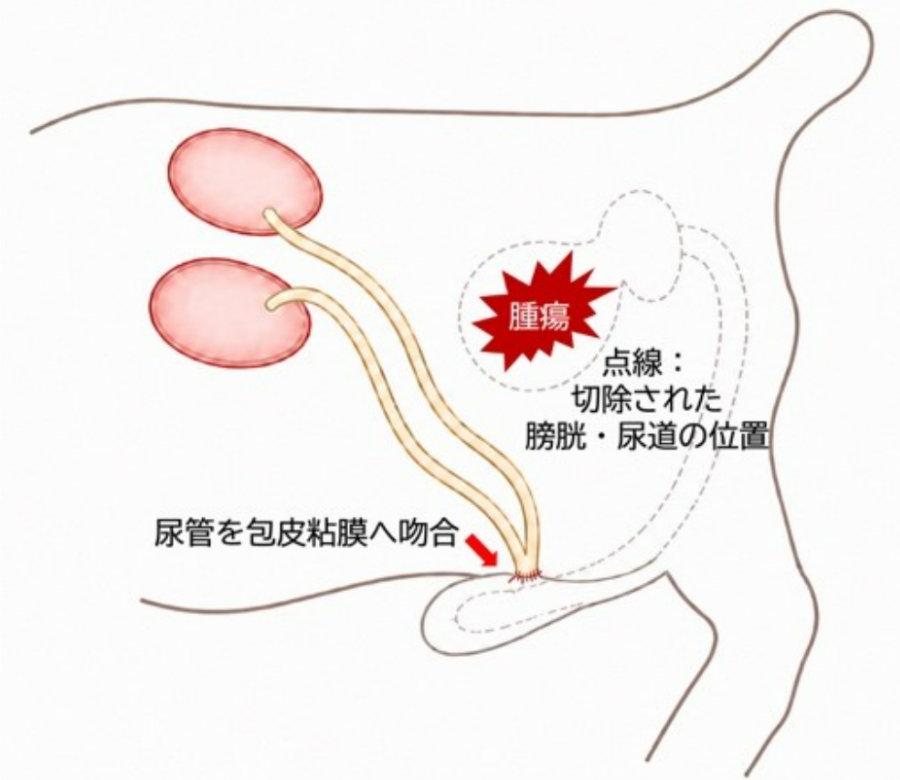 手術術式模式図。膀胱・前立腺・尿道を含む尿路を広範囲に切除（膀胱尿路全摘）し、左右の尿管を包皮粘膜へ吻合