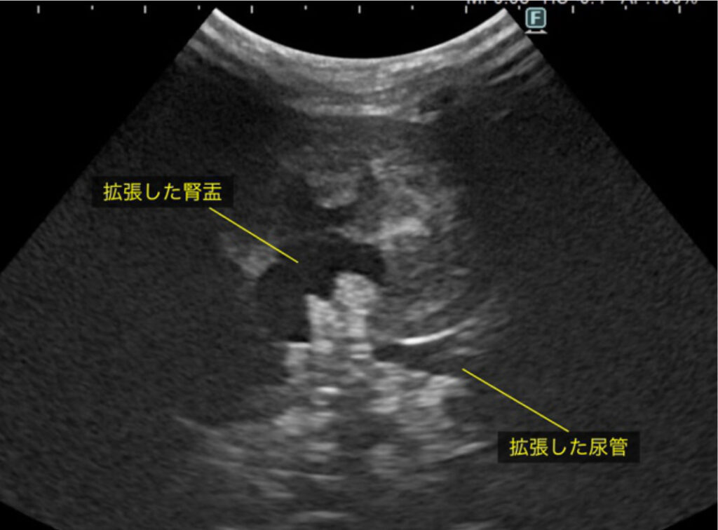 治療開始前：尿道腫瘍による排尿障害に伴い、腎盂と尿管の拡張が認められ、腎臓への負担が懸念される状態